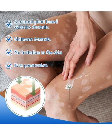 2Pcs Vitiligo Cream Vitiligo Pommade Cr me De Soin Des Points De Fleurs Cr me pour la Peau Vitiligo Cr me De Soin Vitiligo Pour La Peau Vitiligo - Buy Online on GoSupps.com