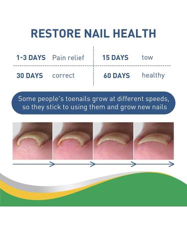 Fitmedify Ingrown Toenail Corrector Kit - Nail Patches for Ingrown Toenail Treatment and Removal - Buy Online on GoSupps.com