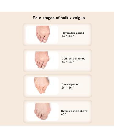 Hallux Valgus Corrector - Adjustable Orthopedic Bunion Toe Straightener for Day and Night - Buy Online on GoSupps.com