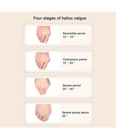 Hallux Valgus Corrector with Adjustable Bunion Splint - Ergonomic Recovery Aid - Buy Online on GoSupps.com