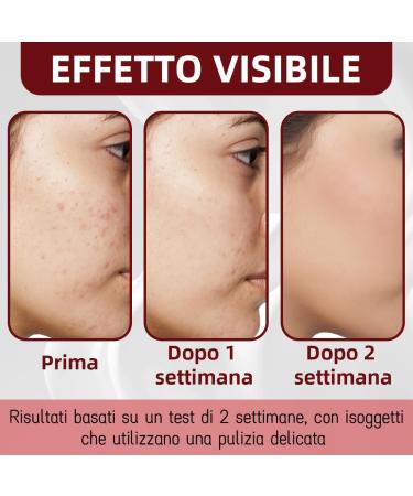 LAKPYN AntiPimple Cream 35 g Fights Pimples And Impurities Effective Acne Cream For Clear And Healthy Skin Suitable For All Skin Types - Buy Online on GoSupps.com