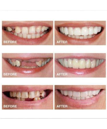 Dentures Fake Smile Teeth - Moldable & Customizable Top Teeth for Instant Snap On - Temporary Solution for Confidence Smile (3 Boxes) - Buy Online on GoSupps.com