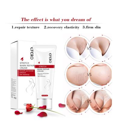 Effective Stretch Marks Removal Cream for Women Targets Pregnancy & Acne Marks Moisturizes & Firms Skin - Buy Online on GoSupps.com