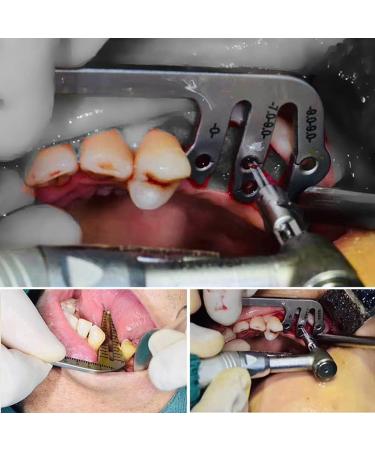 JMYSD Dental Implant Guide Set | Orientation Aid & Punch Pliers for Dentists | Precision Dental Tools for International Shipping - Buy Online on GoSupps.com