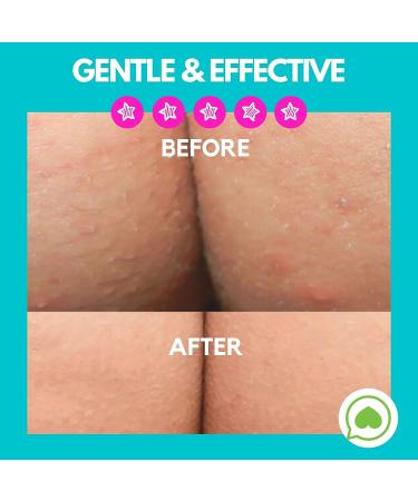 Acne Clearing Lotion for Butt, Back, Bum & Thigh - Special Treatment Formula for Pimples, Ingrown Hairs, Razor Burn, Blackheads & Blemishes - Vegan & Cruelty Free - Buy Online on GoSupps.com
