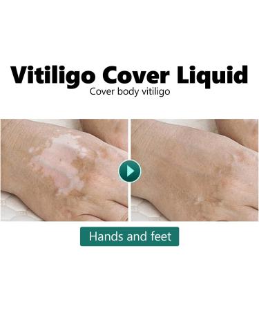 Vitiligo Corrector Professional Vitiligo Coverage Liquid for Daily Use for Face and Body - Buy Online on GoSupps.com
