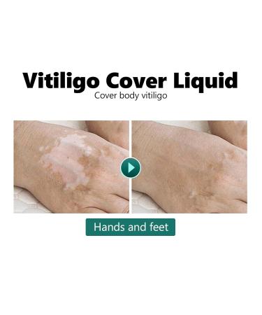 Vitiligo Concealer - Waterproof Natural Look Cover Up for Face & Body | Everyday Use Mild Cosmetics - Buy Online on GoSupps.com