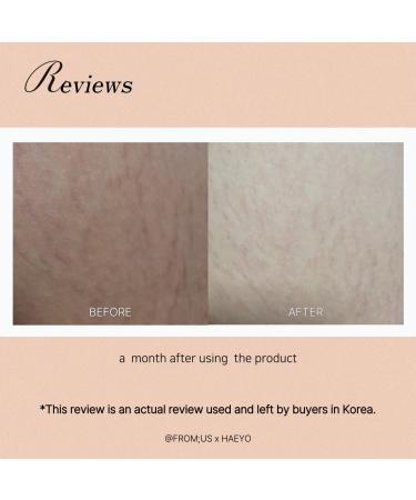 Antley Stretch Care Cream | Gel-Type Ointment for Pregnant Dieters & Adolescents | Effective Medical Device | International Shipping - Buy Online on GoSupps.com