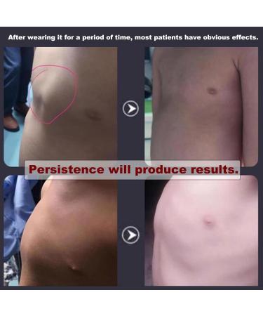 SUZLAZYR Pectus Carinatum Orthosis Brace Thoracic Depression Brace Pigeon Chest Support Medical Ribs Valgus Orthosis Braces Comfortable and Breathable S - Buy Online on GoSupps.com