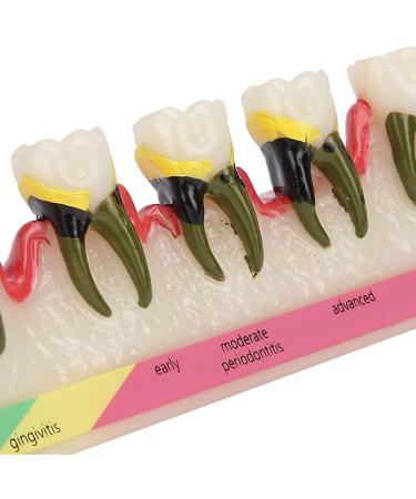 Dental Periodontitis Model | Periodontal Development Study Tool for Dental Research & Learning - Buy Online on GoSupps.com