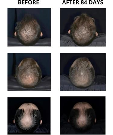 Sattva Ayurveda Hair Growth Serum with Rosemary Extract and Redensyl for Effective Treatment of Hair Loss in Women and Men - Buy Online on GoSupps.com