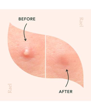 Rael Pimple Patches - Hydrocolloid Acne Spot Treatment for Blemishes and Zits - 24 Count Pink Facial Stickers - Buy Online on GoSupps.com