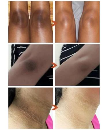 GFOUK Acanthoclear Therapy Spray - Dark Spot Corrector for Black Skin (1PCS) - Buy Online on GoSupps.com