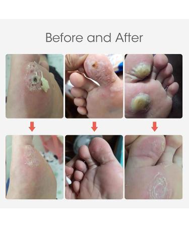 MQUPIN Corn Remover Pads Wart Remover Pads Foot Corn Remover Pads Plantar Wart Removal Corn Callus Remover Penetrates and Removes Common and Plantar Warts with Hole Callus Stops Wart Regrowth (24 PCS) - Buy Online on GoSupps.com