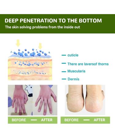 Maximum Strength 42% Urea Foot Cream Callus Remover for Dry, Hard Skin - Cracked Heel Repair 50g - Buy Online on GoSupps.com