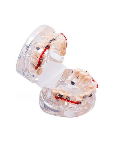 Easyinsmile Dental Orthodontic Treatment Model with Braces - Metal & Ceramic - Buy Online on GoSupps.com
