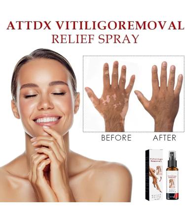 DENGWANG Vitiligo & Psoriasis Relief Spray - Reduces White Spots on Skin (3PCS) - Buy Online on GoSupps.com