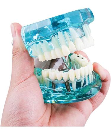Buy Lmeil Transparent Dental Teeth Model - Ideal for Implantation & Dentist Research | Pathological Dental Model - Buy Online on GoSupps.com