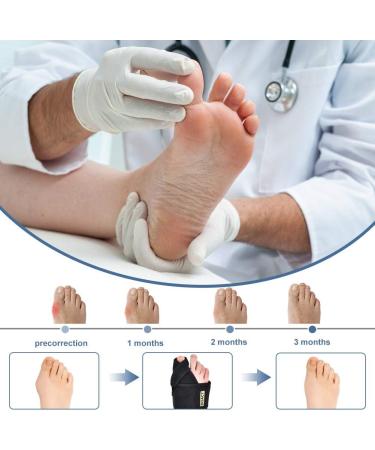 Bunion Corrector: Adjustable Orthopedic Toe Straightener for Overlapping Toes - Men & Women - Buy Online on GoSupps.com