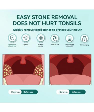 Oral Care Tool Set - Electric Tonsil Stone Remover & Suction Tool for Effective Oral Hygiene | TO008 - Buy Online on GoSupps.com
