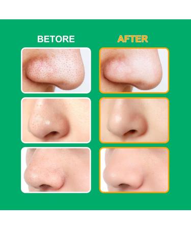 Premium Hydrocolloid Nose Strips & Face Strips - 10 Nose Strips + 20 Face Strips for Blackhead Removal Whitehead Treatment Hydration & Firming - Buy Online on GoSupps.com