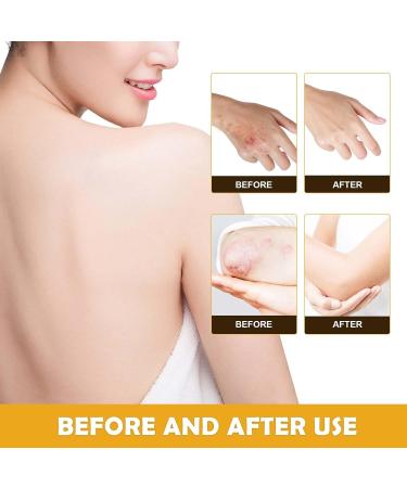 Buy Bee Venom Cream for Psoriasis & Warts - Natural Soothing Treatment Worldwide Shipping - Buy Online on GoSupps.com
