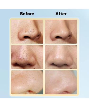 Blackhead Remover Solution 500ml - Deep Cleansing for Soft Skin Pore Cleaning & Moisture Boost | International Shipping - Buy Online on GoSupps.com