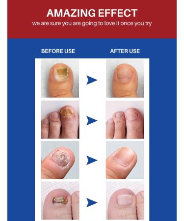 Nail Treatment Repair Toe Nail Repair Treatment Extra Strength Toenail Repair Solution Nail Renewal Liquid For Discoloration Nail & Toenails(10ML) - Buy Online on GoSupps.com