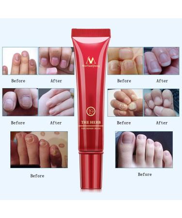 Herbal Foot Nail Cream Protector Skin Care Cream Ointment Treatment Toe Nail Onychomycosis Paronychia Anti Fungal Treatment Nail Repair Cream 15g - Buy Online on GoSupps.com