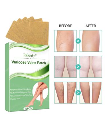 Varicose Veins Patch - Effective Treatment for Spider Veins | 12 Pcs | Fast International Shipping - Buy Online on GoSupps.com
