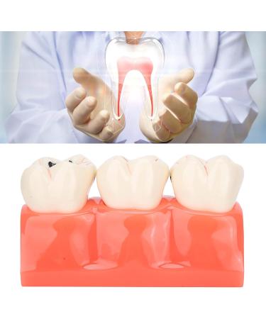 Verdant Touch Simulation Teeth Caries Model - Removable Tooth Caries Demonstration for Dental Education | International Shipping - Buy Online on GoSupps.com