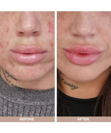 Face Tonic with Lemon Myrtle 150ml - Alcohol Free face Tonic with Tea Tree Oil - Cleanser for Blemishes Spots pimples and Acne Prone Skin Natural & Pharmaceutical Grade Australian Tea Tree Oil - Buy Online on GoSupps.com