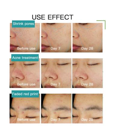 Organic Facial Serum for Acne - 2% Salicylic Acid for Breakouts Redness & Skin Barrier - Buy Online on GoSupps.com