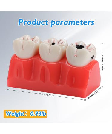 Buy Dental Caries Teeth Model - 4X Removable Tooth Decay & Pathology Display | International Shipping - Buy Online on GoSupps.com