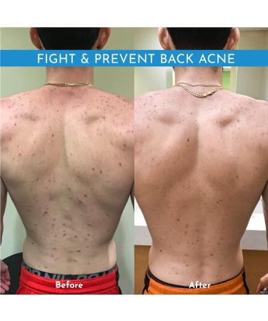 Truly Clear Acne Bar: Alcohol-Free Face & Body Cleanser with Hyaluronic Acid - Non-Drying Acne Treatment for Face, Chest, Butt, and Back - Buy Online on GoSupps.com