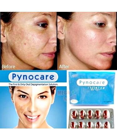 Nakarad Pynocare White Melasma Treatment - 20 Capsules - Buy Online on GoSupps.com