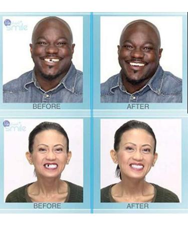 Instant Smile Multi-Shade Temporary Tooth Repair Kit - Patented Solution - Buy Online on GoSupps.com