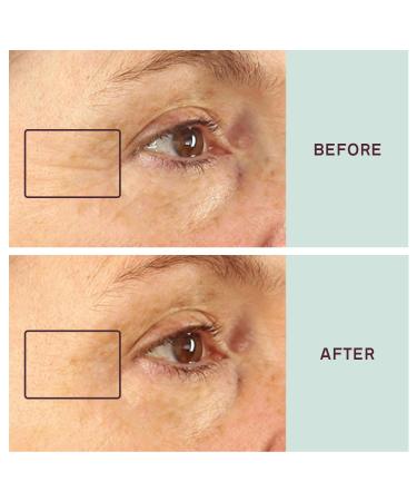 Dermaclara Silicone Face Patches Kit - Anti-Wrinkle Patches for Frown & Smile Lines Silicone Anti-Wrinkle Reusable Pads Up to 30 Uses - 1 Forehead 4 Eye & Mouth 1 Cleanser 1 Peptide Lip Serum - Buy Online on GoSupps.com