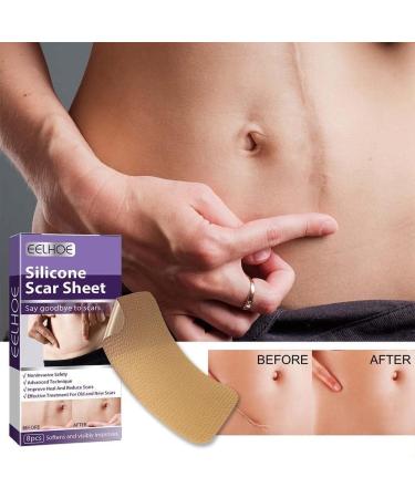 Silicone Gel Scar Removal Patch - Self-Adhesive Tape for Burn Trauma, Acne & Surgery Scars - Skin Repair Therapy - Buy Online on GoSupps.com