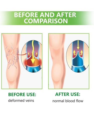 TUITUII Varicose veins spider vein patch spider vein patch veinfree herbal patches antivaricose veins soothing legs veins removal patch 20 g - Buy Online on GoSupps.com