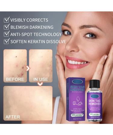 LDREAMAM Skin Tag Removal Gel - Safe & Effective Mole & Wart Remover - Buy Online on GoSupps.com