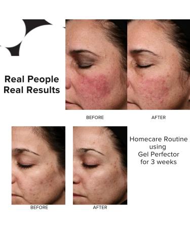 PRIORI Skincare Gel Perfector for Acne & Oily Skin | Salicylic & Lactic Acid Treatment | Oil Control Blemishes & Wrinkles | Fragrance Free 1 fl oz - Buy Online on GoSupps.com