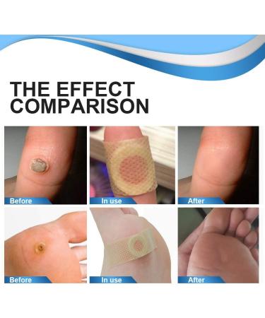 24Pcs WartRemover Pads Foot Corn Removal Plaster with Hole Penetrates and Removes Common and Plantar Warts 2023 New Warts Off Removal Pads for All Skin Types - Buy Online on GoSupps.com