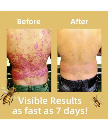 Bee Venom Psoriasis Treatment Cream - Soothing Moisturizer for Skin - Professional New Zealand Formula (5pcs) - Buy Online on GoSupps.com