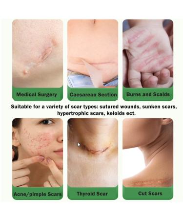 Silicone Scar Sheets 1.6 x 120 Tape Roll | Keloid & Surgical Scar Treatment | Tummy Tucks, C-Section, Burn, Acne, Stretch Marks | Wound Bandages - Buy Online on GoSupps.com