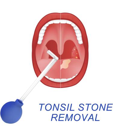 Tonsil Stone Remover Tool - Effective Almond Stones Caster Glass for Oral Hygiene | Mandelsaugers Tonsillenstein Remover for Mouth Cleaning - Buy Online on GoSupps.com