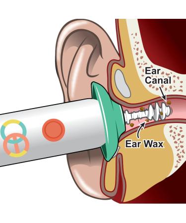 Oto-Tip Electric Silicone Spiral Earwax Series (Replacement Tip(Mix)) - Buy Online on GoSupps.com