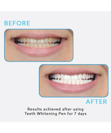 GO SMILE On The Go Teeth Whitening Pen - Clinically Proven, No Sensitivity, 1.3mL - Kosher Teeth Treatment for Men & Women - Buy Online on GoSupps.com