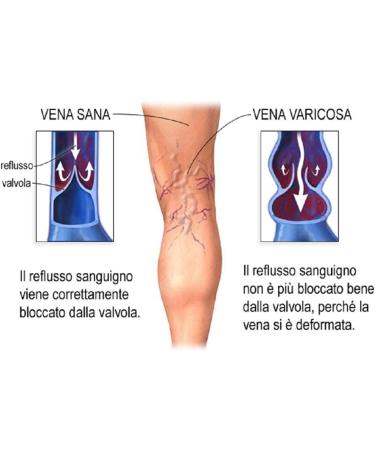 CREAM AGAINST VARICOUS VEINS FIRST CLASS 2019-2021 VARICASTAN VIVA Natura 100% NATURAL PARABENS FREE COLD WORKED Italian Packaging The original 100% - Buy Online on GoSupps.com