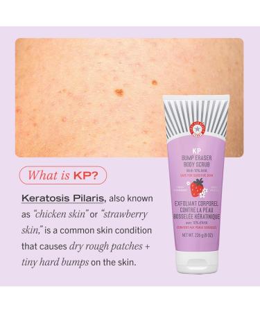 First Aid Beauty KP Bump Eraser Body Scrub - 10% AHA Exfoliant for Keratosis Pilaris Strawberry Scent 8 oz - Smooth Skin & Reduce Bumps - Buy Online on GoSupps.com